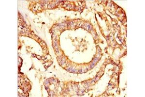 Immunohistochemistry of paraffin-embedded human endometrial cancer using ABIN7161918 at dilution of 1:100 (NRBP2 Antikörper  (AA 12-258))
