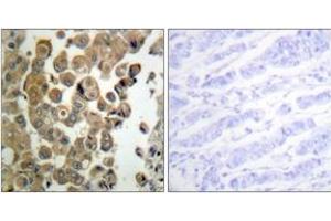 Immunohistochemistry analysis of paraffin-embedded human breast carcinoma, using PKC delta (Phospho-Thr505) Antibody.