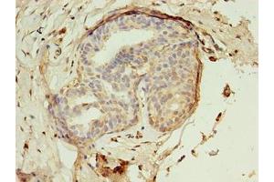 Immunohistochemistry of paraffin-embedded human breast cancer using ABIN7142288 at dilution of 1:100 (EBP Antikörper  (AA 2-230))