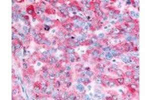 Human Ovarian Carcinoma (formalin-fixed, paraffin-embedded) stained with EGFR antibody ABIN213614 at 2. (EGFR Antikörper)