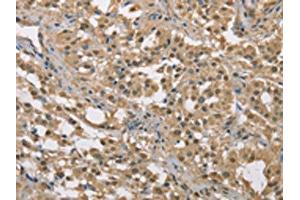 The image on the left is immunohistochemistry of paraffin-embedded Human thyroid cancer tissue using ABIN7129149(DACH2 Antibody) at dilution 1/40, on the right is treated with fusion protein. (DACH2 Antikörper)