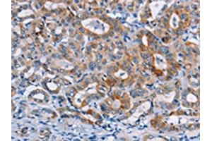 The image on the left is immunohistochemistry of paraffin-embedded Human thyroid cancer tissue using ABIN7128771(CASC3 Antibody) at dilution 1/20, on the right is treated with fusion protein. (CASC3 Antikörper)