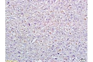 Formalin-fixed and paraffin embedded human cervical carcinoma labeled with Anti Sertad1 Polyclonal Antibody, Unconjugated  at 1:200 followed by conjugation to the secondary antibody and DAB staining