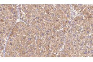 ABIN6277133 at 1/100 staining Human Melanoma tissue by IHC-P. (ELSPBP1 Antikörper  (C-Term))