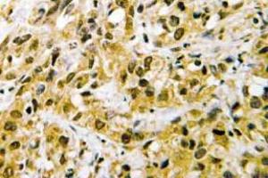 Immunohistochemistry (IHC) analyzes of NF-YC antibody in paraffin-embedded human liver carcinoma tissue. (NFYC Antikörper)