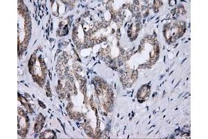 Immunohistochemical staining of paraffin-embedded Carcinoma of thyroid tissue using anti-LIPG mouse monoclonal antibody. (LIPG Antikörper)