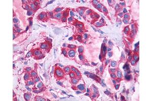 Anti-GPR110 antibody IHC of human Breast, Carcinoma.