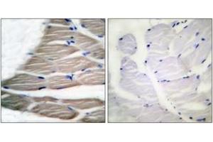 Immunohistochemistry analysis of paraffin-embedded human breast carcinoma, using ACC1 (Phospho-Ser80) Antibody. (Acetyl-CoA Carboxylase alpha Antikörper  (pSer80))