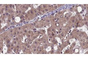 ABIN6277491 at 1/100 staining Human liver cancer tissue by IHC-P. (PAK1 Antikörper  (Internal Region))
