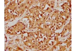 IHC image of ABIN7127533 diluted at 1:125 and staining in paraffin-embedded human liver cancer performed on a Leica BondTM system.