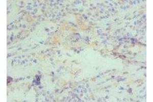 Immunohistochemistry of paraffin-embedded human breast cancer using ABIN7150954 at dilution of 1:100 (CBX4 Antikörper  (AA 401-560))