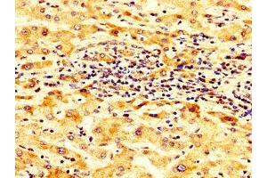 IHC image of ABIN7143973 diluted at 1:300 and staining in paraffin-embedded human liver cancer performed on a Leica BondTM system. (SCNN1B Antikörper  (AA 554-640))