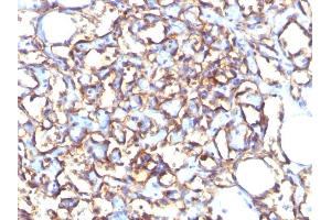 Formalin-fixed, paraffin-embedded human Angiosarcoma stained with Podocalyxin Mouse Monoclonal Antibody (3D3). (PODXL Antikörper  (Extracellular Domain))
