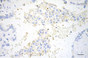 Immunohistochemistry was performed on paraffin-embedded human lung adenocarcinoma using CD274 antibody (ABIN7797962), 1:200). (Rekombinanter PD-L1 Antikörper)