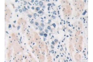 Detection of PKD2 in Human Stomach cancer Tissue using Polyclonal Antibody to Protein Kinase D2 (PKD2) (PKD2 Antikörper  (AA 621-832))