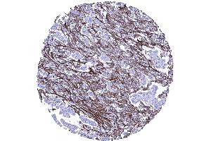 Abundant periostin positive stroma in an invasive lobular breast cancer (Periostin Antikörper  (AA 193-326))