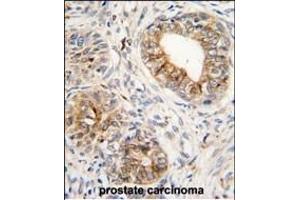 Formalin-fixed and paraffin-embedded human prostata carcinoma tissue reacted with PTGS1 antibody (C-term) (ABIN1882120 and ABIN2839444) , which was peroxidase-conjugated to the secondary antibody, followed by DAB staining. (PTGS1 Antikörper  (C-Term))