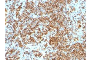 Formalin-fixed, paraffin-embedded human Lymphoma stained with CD45RB Monoclonal Antibody (PTPRC/1132). (CD45 Antikörper)