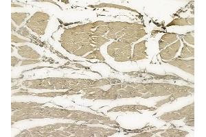 ABIN6255930 and ABIN6267202 at 1/100 staining human tongue carcinoma by IHC-P.