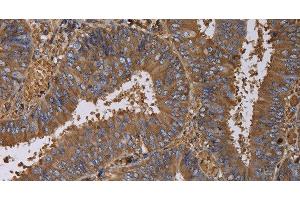 Immunohistochemistry of paraffin-embedded Human colon cancer using FADS1 Polyclonal Antibody at dilution of 1:60 (FADS1 Antikörper)