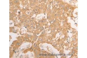 Immunohistochemistry of Human lung cancer using NAP1L1 Polyclonal Antibody at dilution of 1:50 (NAP1L1 Antikörper)