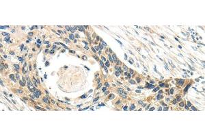 Immunohistochemistry of paraffin-embedded Human esophagus cancer tissue using CCL13 Polyclonal Antibody at dilution 1:40 (CCL13 Antikörper)