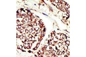Formalin-fixed and paraffin-embedded human cancer tissue reacted with the primary antibody, which was peroxidase-conjugated to the secondary antibody, followed by DAB staining.