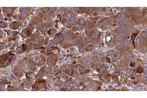 ABIN6273837 at 1/100 staining Human liver cancer tissue by IHC-P. (Serotonin Receptor 3A Antikörper  (Internal Region))