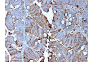 Formalin-fixed, paraffin-embedded human Colon Carcinoma stained with MerTK Mouse Monoclonal Antibody (MERTK/3015).