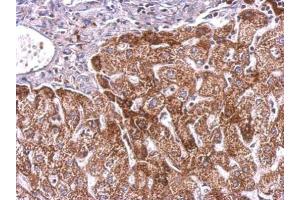 IHC-P Image PLGF antibody detects PGF protein at cytosol on human hepatoma by immunohistochemical analysis. (PLGF Antikörper)