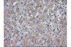 Immunohistochemical staining of paraffin-embedded Carcinoma of Human prostate tissue using anti-ACAT2 mouse monoclonal antibody. (ACAT2 Antikörper)