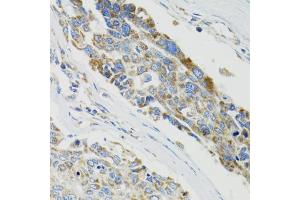 Immunohistochemistry of paraffin-embedded human liver cancer using SH2B1 Antibody (ABIN5973245) at dilution of 1/100 (40x lens). (SH2B1 Antikörper)