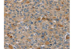 The image on the left is immunohistochemistry of paraffin-embedded Human liver cancer tissue using ABIN7130584(PEF1 Antibody) at dilution 1/20, on the right is treated with fusion protein. (PEF1 Antikörper)