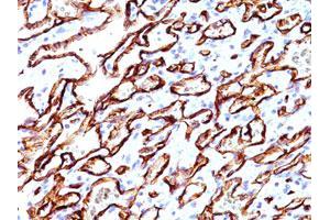 Immunohistochemical staining of human angiosarcoma (20X) with PODXL monoclonal antibody, clone 3D3  at 1:500 dilution. (PODXL Antikörper  (Extracellular Domain))