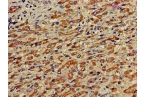 Immunohistochemistry of paraffin-embedded human liver cancer using ABIN7155043 at dilution of 1:100 (c-MET Antikörper  (AA 83-209))