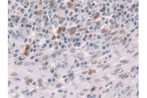 IHC-P analysis of Human Colorectal cancer Tissue, with DAB staining. (Glucocorticoid Receptor Antikörper  (AA 532-730))
