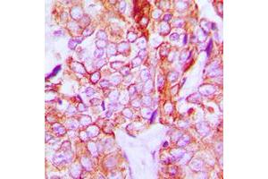 Immunohistochemical analysis of HER3 (pY1328) staining in human breast cancer formalin fixed paraffin embedded tissue section.