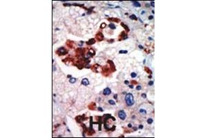 Formalin-fixed and paraffin-embedded human cancer tissue reacted with the primary antibody, which was peroxidase-conjugated to the secondary antibody, followed by AEC staining. (PKC iota Antikörper  (N-Term))