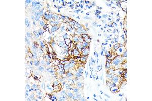 Immunohistochemistry of paraffin-embedded Human lung cancer using ICAM-1/CD54 antibody (ABIN7267941) at dilution of 1:100 (40x lens). (ICAM1 Antikörper)