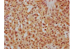 IHC image of ABIN7155258 diluted at 1:400 and staining in paraffin-embedded human liver cancer performed on a Leica BondTM system. (HRG Antikörper  (AA 412-511))