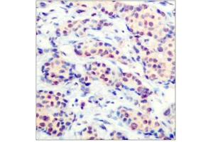 Immunohistochemical analysis of paraffin-embedded human breast carcinoma tissue using JunD(Ab-255) Antibody (JunD Antikörper)