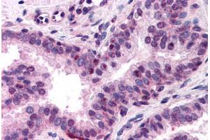 Human Prostate (formalin-fixed, paraffin-embedded) stained with NFYA antibody ABIN218318 at 1:400 followed by biotinylated goat anti-rabbit IgG secondary antibody ABIN481713, alkaline phosphatase-streptavidin and chromogen. (NFYA Antikörper  (N-Term))