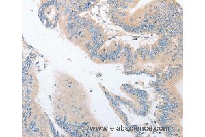 Immunohistochemistry of Human colon cancer using EPS15L1 Polyclonal Antibody at dilution of 1:30 (EPS15L1 Antikörper)