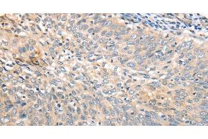 Immunohistochemistry of paraffin-embedded Human cervical cancer tissue using APTX Polyclonal Antibody at dilution 1:50 (Aprataxin Antikörper)