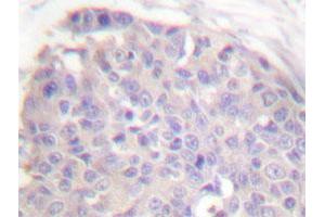 Immunohistochemical analysis of paraffin-embedded human breast cancer tissue using CARD6 polyclonal antibody . (CARD6 Antikörper)