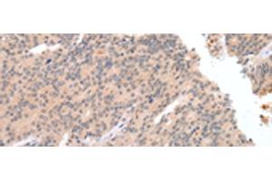 Immunohistochemistry of paraffin-embedded Human prost at e cancer tissue using DEFB112 Polyclonal Antibody at dilution of 1:40(x200) (DEFB112 Antikörper)