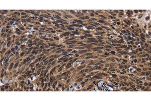 Immunohistochemistry of paraffin-embedded Human cervical cancer tissue using FASTKD5 Polyclonal Antibody at dilution 1:40 (FASTKD5 Antikörper)