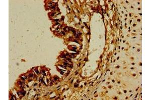 Immunohistochemistry of paraffin-embedded human colon cancer using ABIN7149202 at dilution of 1:100 (CYP1A1 Antikörper  (AA 97-254))