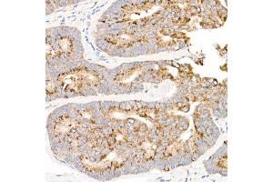Immunohistochemistry of paraffin-embedded human colon carcinoma using MT-ND2 Rabbit pAb (ABIN7268600) at dilution of 1:50 (40x lens). (MT-ND2 Antikörper  (C-Term))