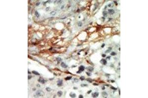 Formalin-fixed and paraffin-embedded human cancer tissue reacted with the primary antibody, which was peroxidase-conjugated to the secondary antibody, followed by AEC staining. (PRKAB2 Antikörper  (N-Term))